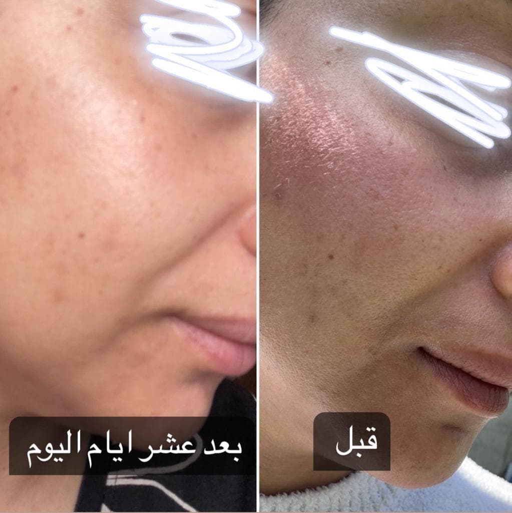 قبل وبعد — حالة 1